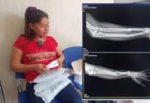 Tarapoto: Adolescente sufre fracturas en ambos brazos tras caer en montículo de construcción dentro de colegio en Picota