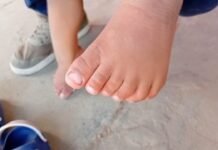 Tarapoto: Padre solicita apoyo para su niño que nació con problemas congénitos, padece de hernias y tiene 23 dedos