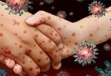 Tarapoto: San Martín refuerza vacunación contra el sarampión ante alerta epidemiológica en el país