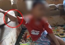 Tarapoto: Niño de 02 años que padece de cáncer necesita apoyo, fue diagnosticado tras aparecer un bulto en el brazo